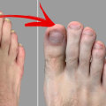 What Does Toenail Fungus Really Look Like? Stages and Pictures of Toenail Fungus With Clear Visuals