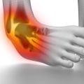 Ankle Sprains: Understanding the Most Prone Side to Injury