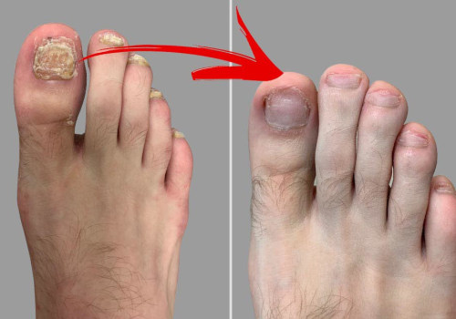 What Does Toenail Fungus Really Look Like? Stages and Pictures of Toenail Fungus With Clear Visuals