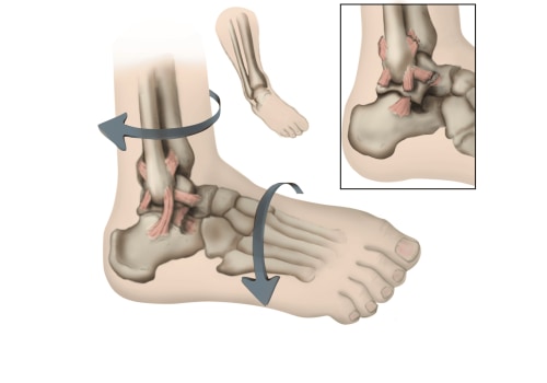 Ankle Injuries: A Podiatrist's Guide to Identification and Treatment